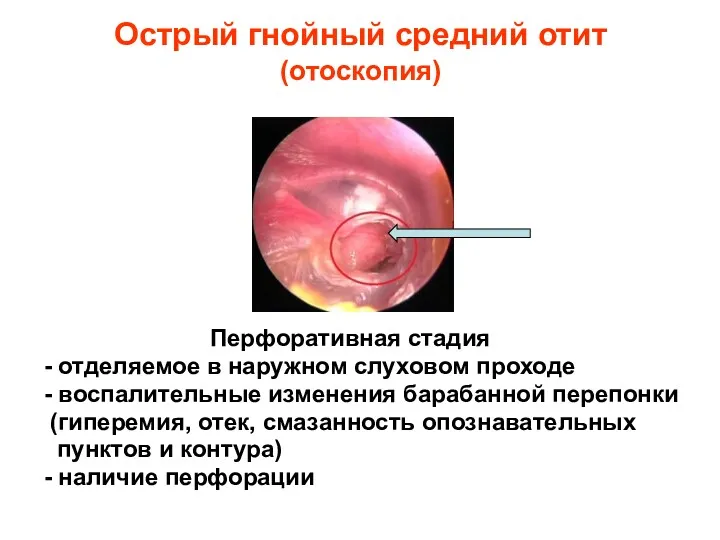 Острый гнойный средний отит (отоскопия) Перфоративная стадия - отделяемое в