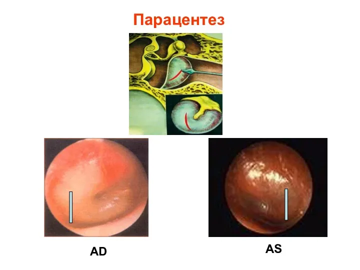 Парацентез AD AS