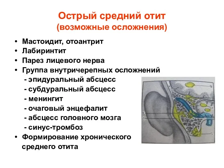 Острый средний отит (возможные осложнения) Мастоидит, отоантрит Лабиринтит Парез лицевого