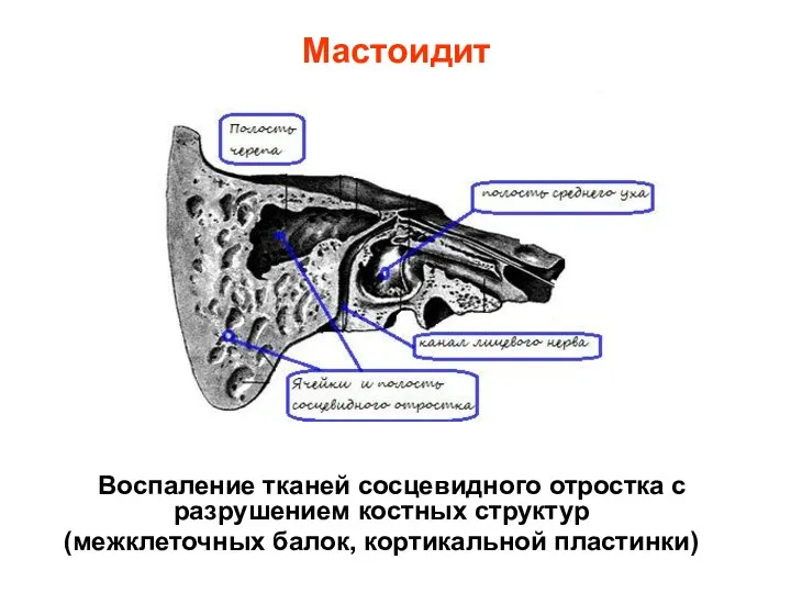 Мастоидит Воспаление тканей сосцевидного отростка с разрушением костных структур (межклеточных балок, кортикальной пластинки)