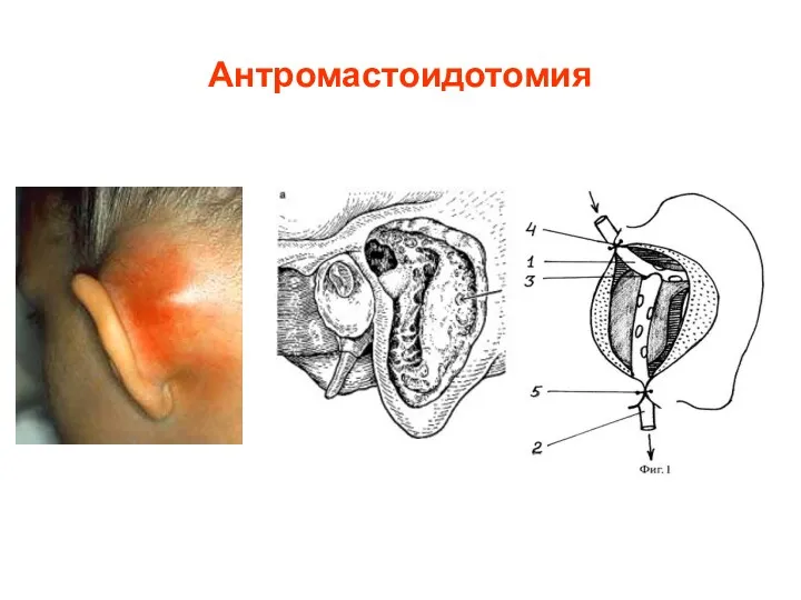 Антромастоидотомия