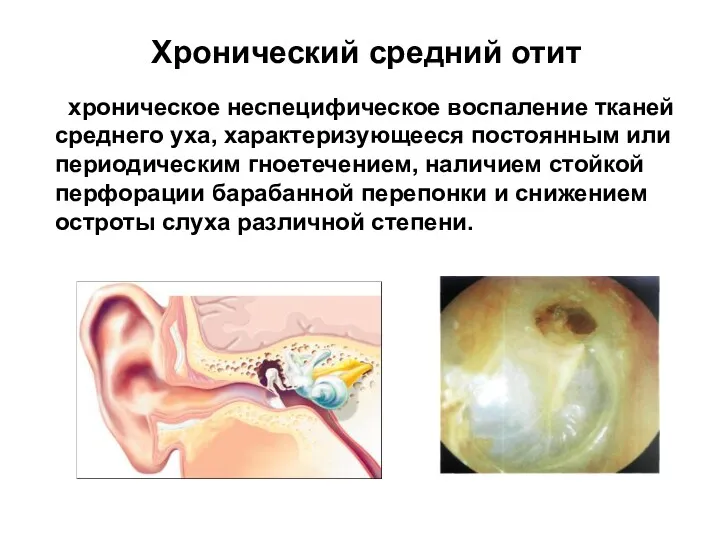 хроническое неспецифическое воспаление тканей среднего уха, характеризующееся постоянным или периодическим