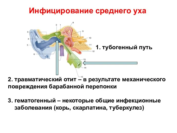 Инфицирование среднего уха 1. тубогенный путь 2. травматический отит –