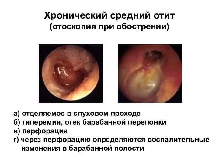 Хронический средний отит (отоскопия при обострении) а) отделяемое в слуховом