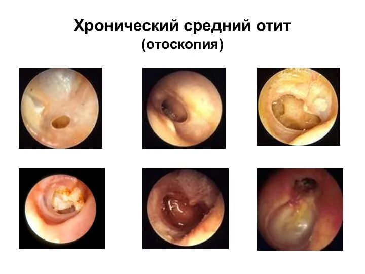 Хронический средний отит (отоскопия)