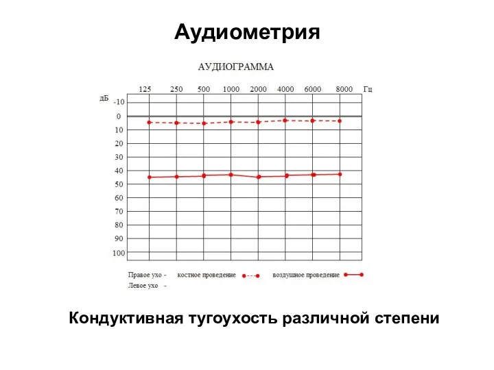 Аудиометрия Кондуктивная тугоухость различной степени