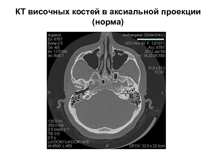 КТ височных костей в аксиальной проекции (норма)