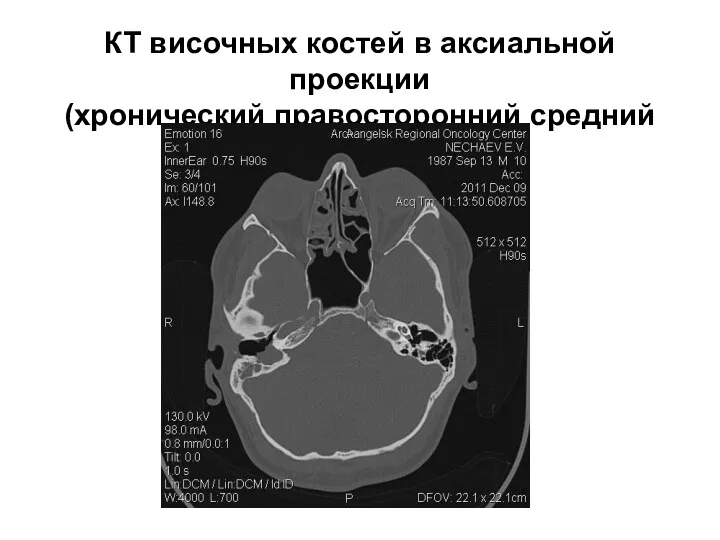 КТ височных костей в аксиальной проекции (хронический правосторонний средний отит)