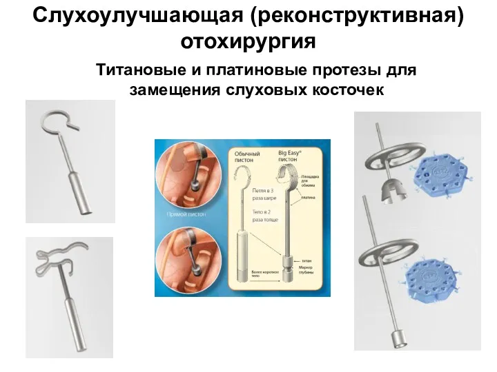 Слухоулучшающая (реконструктивная) отохирургия Титановые и платиновые протезы для замещения слуховых косточек