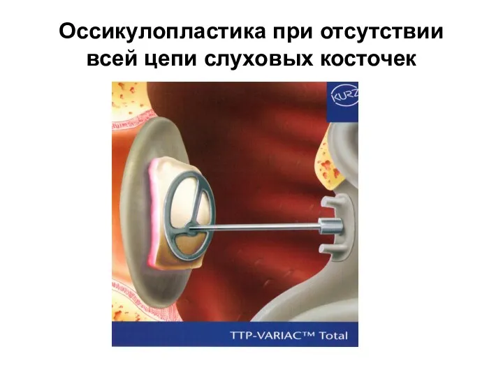 Оссикулопластика при отсутствии всей цепи слуховых косточек