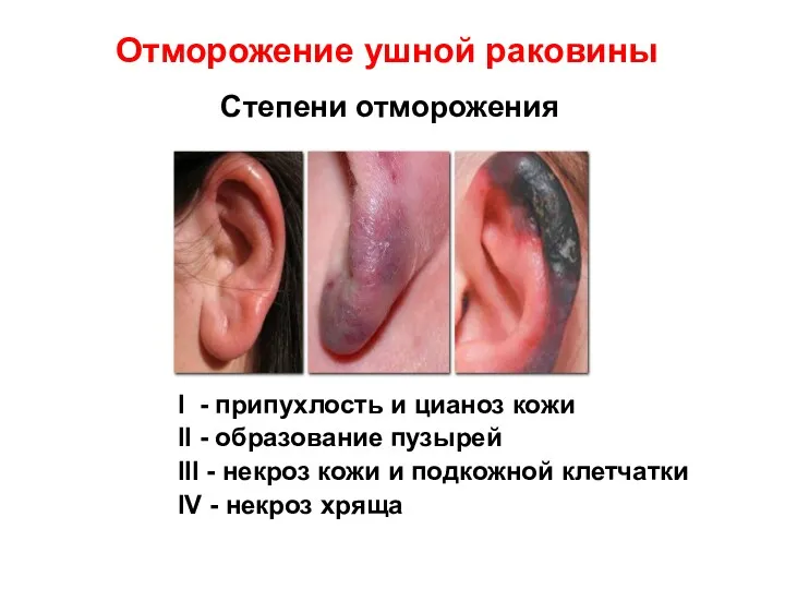 Отморожение ушной раковины I - припухлость и цианоз кожи II