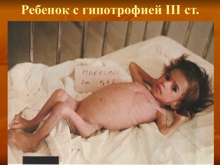 Ребенок с гипотрофией III ст.