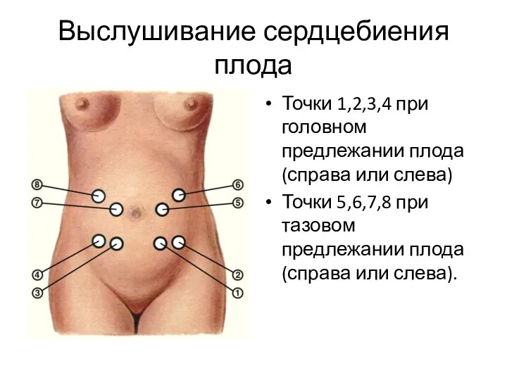 Выслушивание сердцебиения плода Точки 1,2,3,4 при головном предлежании плода (справа