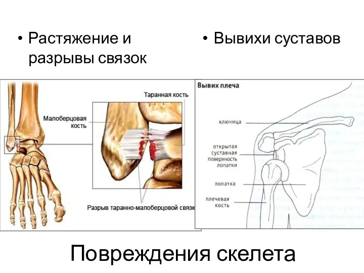 Повреждения скелета Растяжение и разрывы связок Вывихи суставов