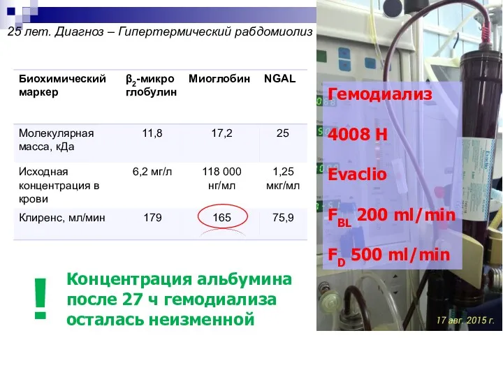 25 лет. Диагноз – Гипертермический рабдомиолиз Гемодиализ 4008 H Evaclio