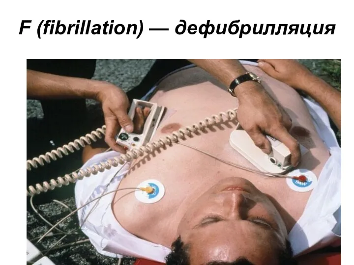 F (fibrillation) — дефибрилляция