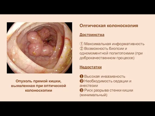 Опухоль прямой кишки, выявленная при оптической колоноскопии Оптическая колоноскопия Достоинства