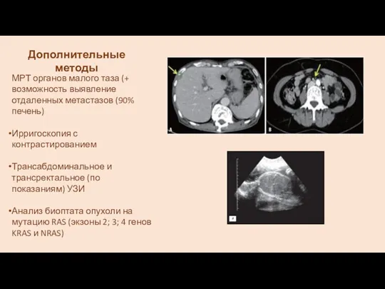 МРТ органов малого таза (+ возможность выявление отдаленных метастазов (90%