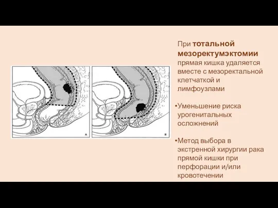 При тотальной мезоректумэктомии прямая кишка удаляется вместе с мезоректальной клетчаткой