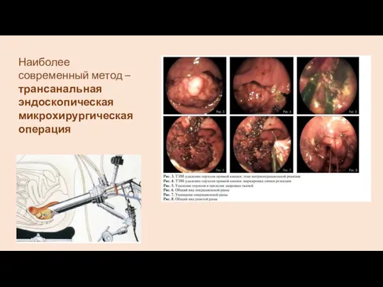 Наиболее современный метод – трансанальная эндоскопическая микрохирургическая операция