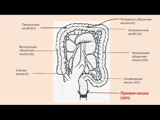 Поперечно-ободочная кишка (6%) Селезеночный изгиб (2%) Печеночный изгиб (8%) Восходящая