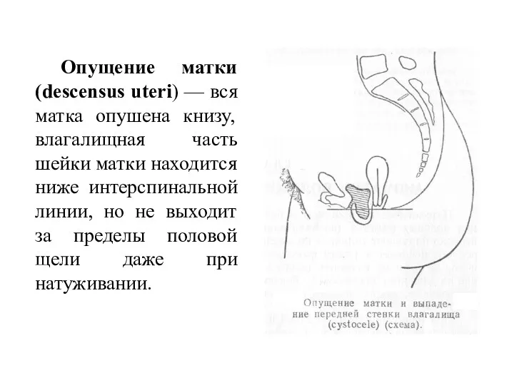 Опущение матки (descensus uteri) — вся матка опушена книзу, влагалищная