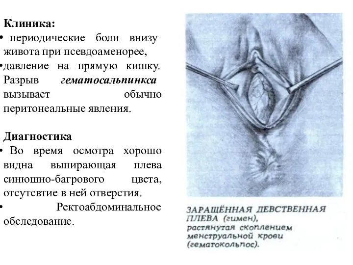 Клиника: периодические боли внизу живота при псевдоаменорее, давление на прямую