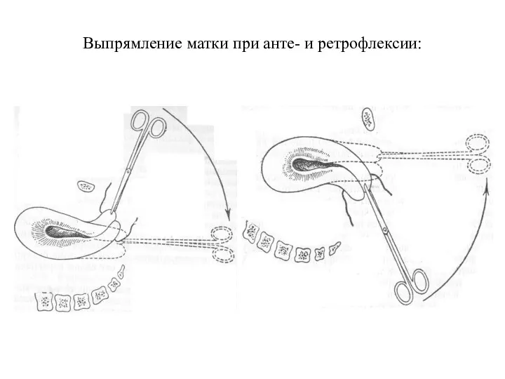 Выпрямление матки при анте- и ретрофлексии: