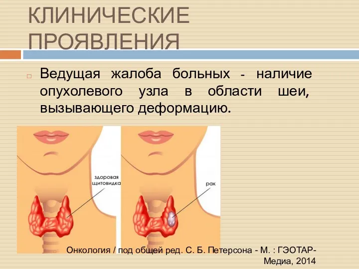 КЛИНИЧЕСКИЕ ПРОЯВЛЕНИЯ Ведущая жалоба больных - наличие опухолевого узла в