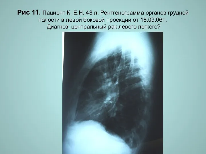 Н.С. Воротынцева. С.С. Гольев Рентгенопульмонология Рис 11. Пациент К. Е.Н.