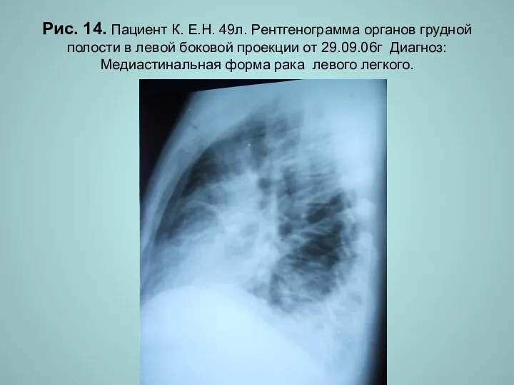 Н.С. Воротынцева. С.С. Гольев Рентгенопульмонология Рис. 14. Пациент К. Е.Н.