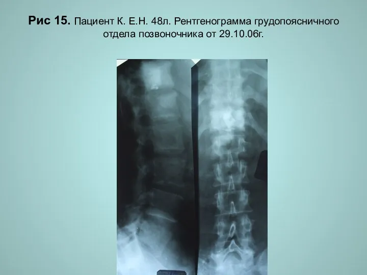 Н.С. Воротынцева. С.С. Гольев Рентгенопульмонология Рис 15. Пациент К. Е.Н.