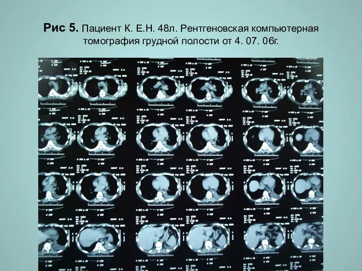 Н.С. Воротынцева. С.С. Гольев Рентгенопульмонология Рис 5. Пациент К. Е.Н.