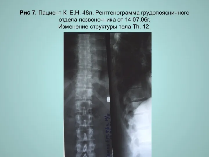 Н.С. Воротынцева. С.С. Гольев Рентгенопульмонология Рис 7. Пациент К. Е.Н.