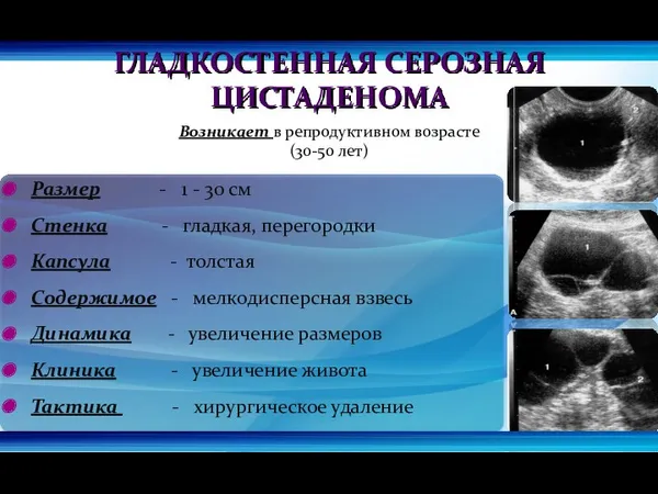 ГЛАДКОСТЕННАЯ СЕРОЗНАЯ ЦИСТАДЕНОМА Возникает в репродуктивном возрасте (30-50 лет) Размер