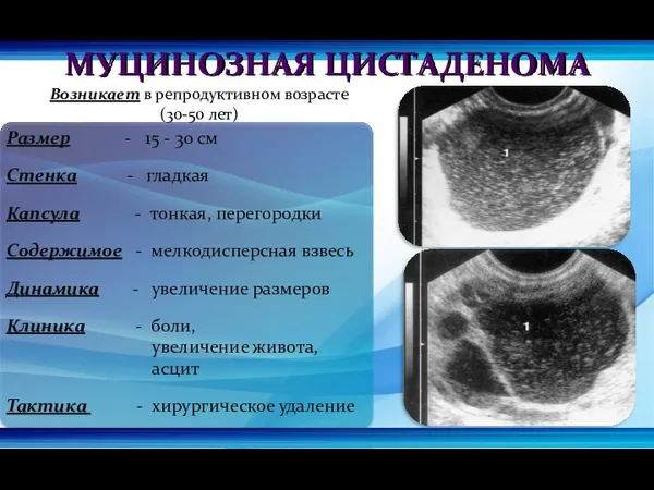 МУЦИНОЗНАЯ ЦИСТАДЕНОМА Возникает в репродуктивном возрасте (30-50 лет) Размер -