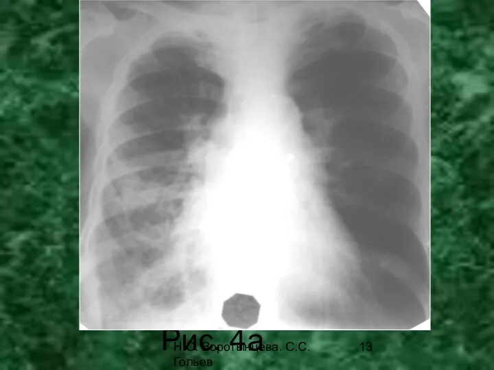 Н.С. Воротынцева. С.С. Гольев Рентгенопульмонология Рис. 4а