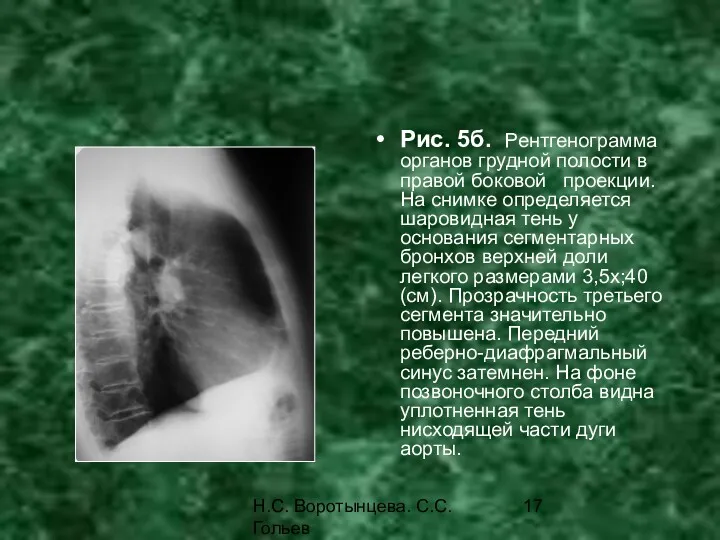 Н.С. Воротынцева. С.С. Гольев Рентгенопульмонология Рис. 5б. Рентгенограмма органов грудной