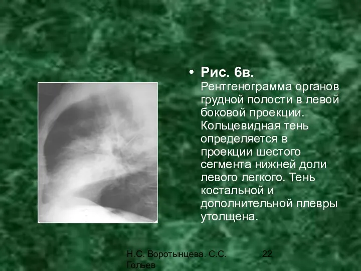 Н.С. Воротынцева. С.С. Гольев Рентгенопульмонология Рис. 6в. Рентгенограмма органов грудной