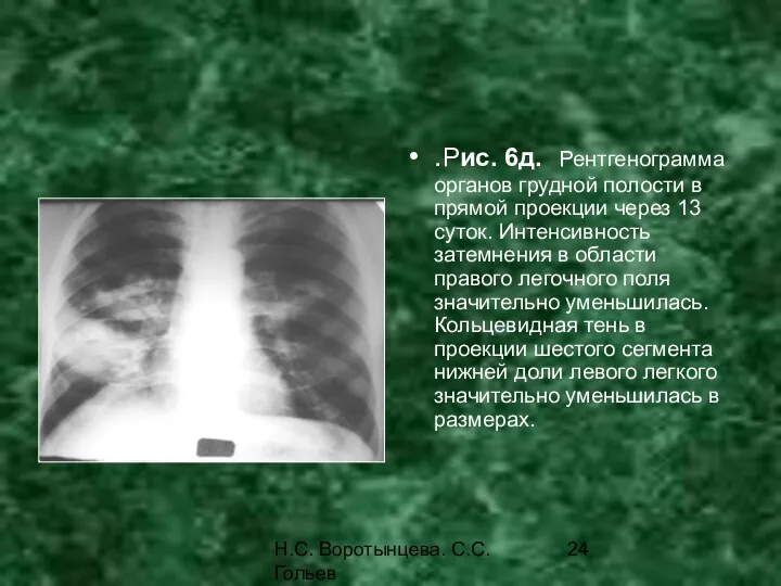 Н.С. Воротынцева. С.С. Гольев Рентгенопульмонология .Рис. 6д. Рентгенограмма органов грудной
