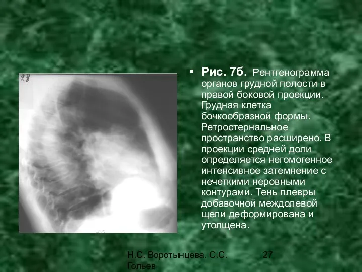 Н.С. Воротынцева. С.С. Гольев Рентгенопульмонология Рис. 7б. Рентгенограмма органов грудной
