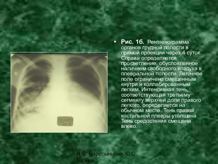 Н.С. Воротынцева. С.С. Гольев Рентгенопульмонология Рис. 1б. Рентгенограмма органов грудной