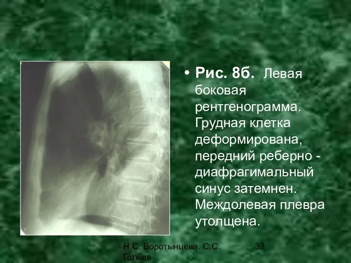 Н.С. Воротынцева. С.С. Гольев Рентгенопульмонология Рис. 8б. Левая боковая рентгенограмма.