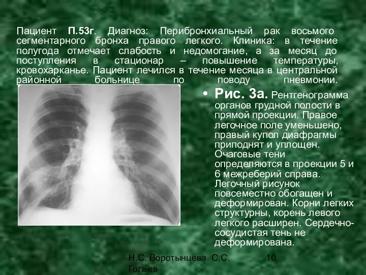 Н.С. Воротынцева. С.С. Гольев Рентгенопульмонология Пациент П.53г. Диагноз: Перибронхиальный рак