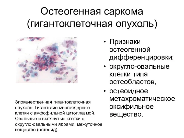 Остеогенная саркома (гигантоклеточная опухоль) Признаки остеогенной дифференцировки: округло-овальные клетки типа