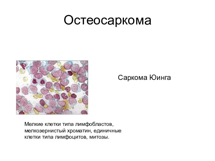 Остеосаркома Саркома Юинга Мелкие клетки типа лимфобластов, мелкозернистый хроматин, единичные клетки типа лимфоцитов, митозы.