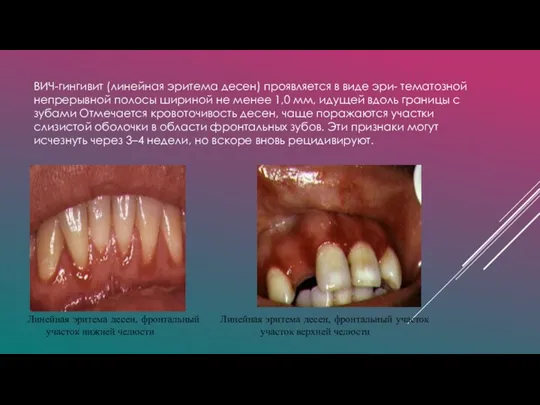 ВИЧ-гингивит (линейная эритема десен) проявляется в виде эри- тематозной непрерывной