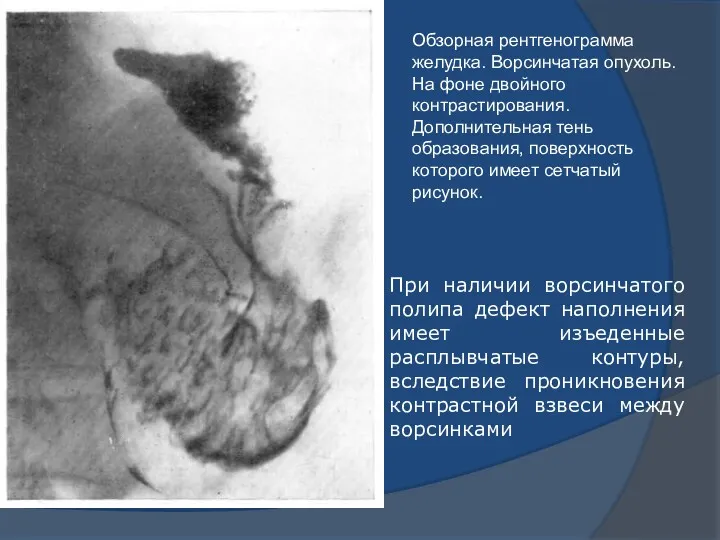 Обзорная рентгенограмма желудка. Ворсинчатая опухоль. На фоне двойного контрастирования. Дополнительная