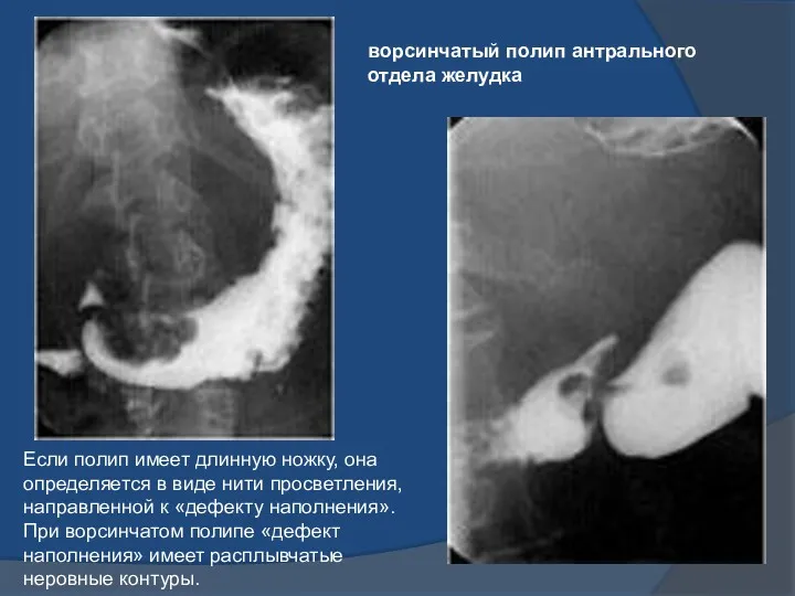 ворсинчатый полип антрального отдела желудка Если полип имеет длинную ножку,