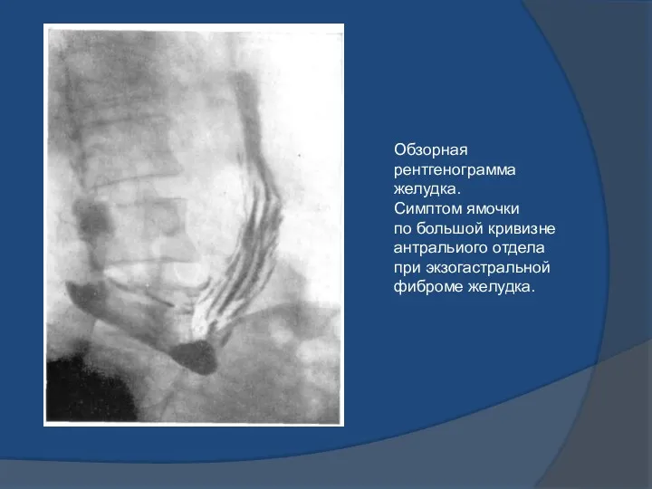 Обзорная рентгенограмма желудка. Симптом ямочки по большой кривизне антральиого отдела при экзогастральной фиброме желудка.
